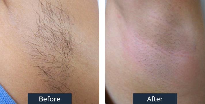 A Before and After Laser Hair Removal by Dr. Craig Jonov