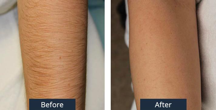 A Before and After of a Laser Arm Hair Removal by Dr. Craig Jonov