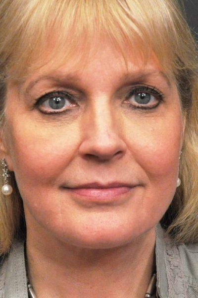 An After photo of a Facelift Plastic Surgery by Dr. Craig Jonov