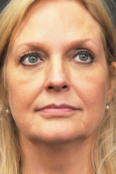 A Before photo of a Facelift Plastic Surgery by Dr. Craig Jonov