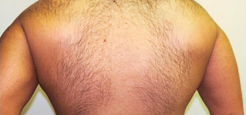 A Before photo of Laser Hair Removal by Dr. Craig Jonov