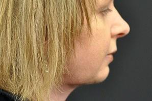 An After photo of a Neck Lift Plastic Surgery by Dr. Craig Jonov