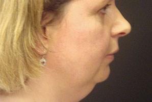 A Before photo of a Neck Lift Plastic Surgery by Dr. Craig Jonov
