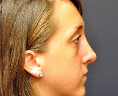 An After photo of a Revision Rhinoplasty Plastic Surgery by Dr. Craig Jonov