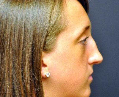 A Before photo of a Revision Rhinoplasty Plastic Surgery by Dr. Craig Jonov