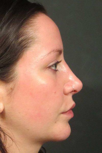 An After photo of a Rhinoplasty Plastic Surgery by Dr. Craig Jonov