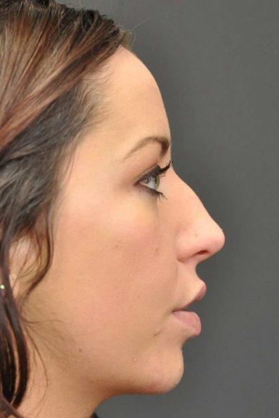 A Before photo of a Rhinoplasty Plastic Surgery by Dr. Craig Jonov