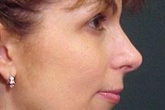 An After photo of a Revision Rhinoplasty Plastic Surgery by Dr. Craig Jonov