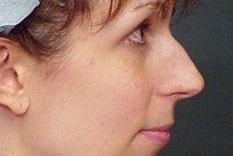 A Before photo of a Revision Rhinoplasty Plastic Surgery by Dr. Craig Jonov