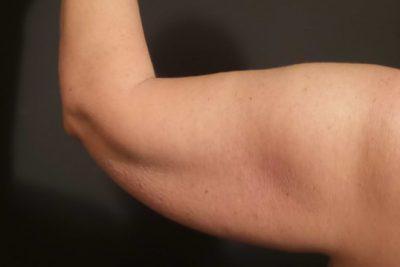A Before photo of an Arm Lift Plastic Surgery by Dr. Craig Jonov