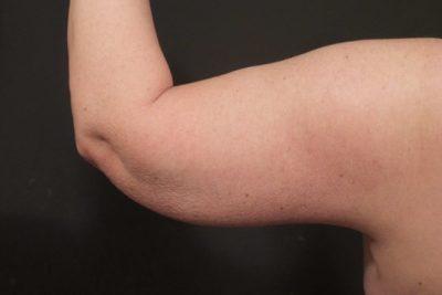 A Before photo of an Arm Lift Plastic Surgery by Dr. Craig Jonov