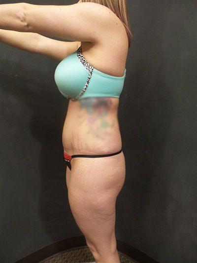 A Before photo of a Brazilian Butt Lift Plastic Surgery by Dr. Craig Jonov