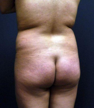 A Before Photo of a Body Contouring Plastic Surgery by Dr. Craig Jonov