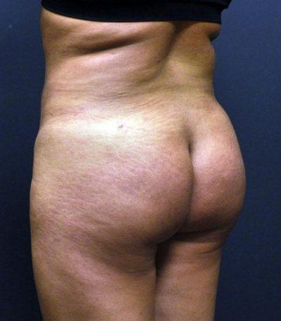 An After photo of a Body Contouring Plastic Surgery by Dr. Craig Jonov