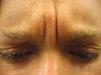 A Before photo of a Botox Treatment by Dr. Craig Jonov