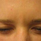 An After photo of a Botox treatment by Dr. Craig Jonov