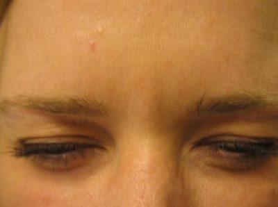 An After photo of a Botox treatment by Dr. Craig Jonov