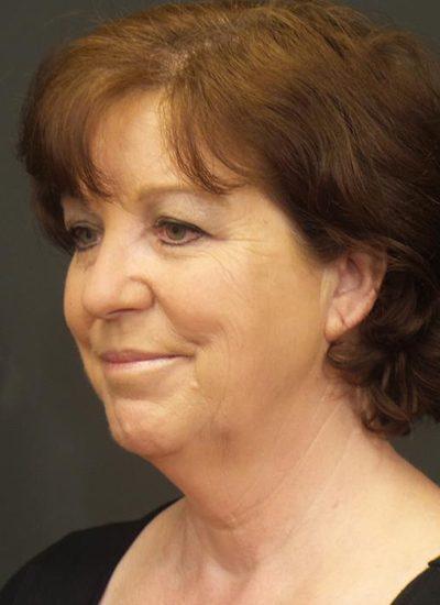 A Before photo of a Fat Transfer Plastic Surgery by Dr. Craig Jonov