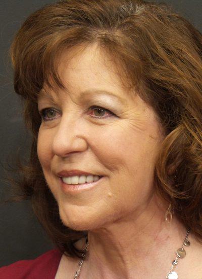 An After photo of Fat Transfer Plastic Surgery by Dr. Craig Jonov