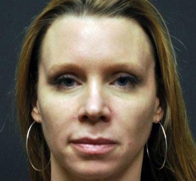 A Before photo of Juvederm Plastic Surgery by Dr. Craig Jonov
