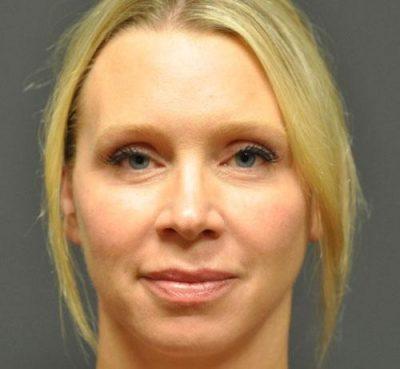 An After photo of Juvederm Plastic Surgery by Dr. Craig Jonov