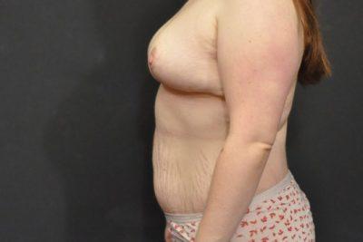 An After photo of a Lower Body Lift Plastic Surgery by Dr. Craig Jonov