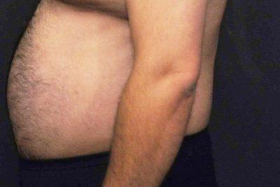 A Before photo of Liposuction Plastic Surgery by Dr. Craig Jonov