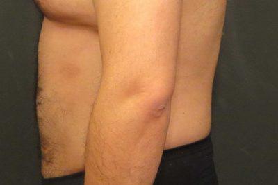 An After photo of Liposuction Plastic Surgery by Dr. Craig Jonov