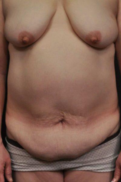 A Before photo of a Mommy Makeover Plastic Surgery by Dr. Craig Jonov