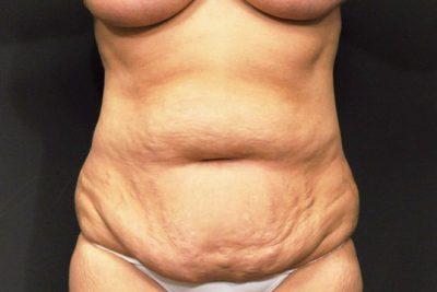 A Before photo of a SmartLipo Plastic Surgery by Dr. Craig Jonov