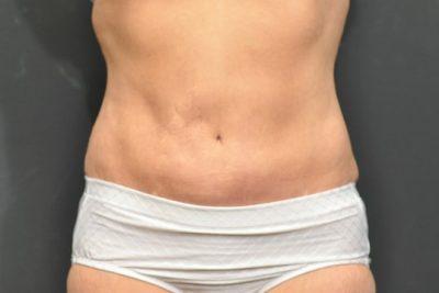 An After photo of a SmartLipo Plastic Surgery by Dr. Craig Jonov