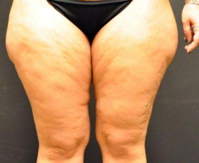 A Before photo of a Thigh Lift Plastic Surgery by Dr. Craig Jonov