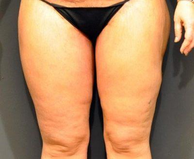 An After photo of a Thigh Lift Plastic Surgery by Dr. Craig Jonov