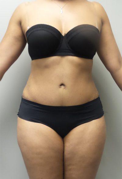 An After photo of a Tummy Tuck Plastic Surgery by Dr. Craig Jonov