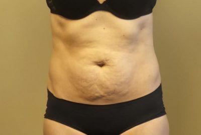 An After photo of an Ultrashape Fat Reduction Plastic Surgery by Dr. Craig Jonov