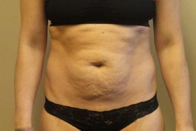 A Before photo of an Ultrashape Fat Reduction Plastic Surgery by Dr. Craig Jonov