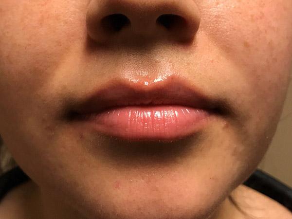 A Before photo of a Lip Filler Plastic Surgery by Dr. Craig Jonov