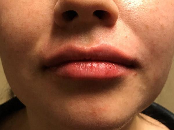 An After photo of Lip Filler Plastic Surgery by Dr. Craig Jonov