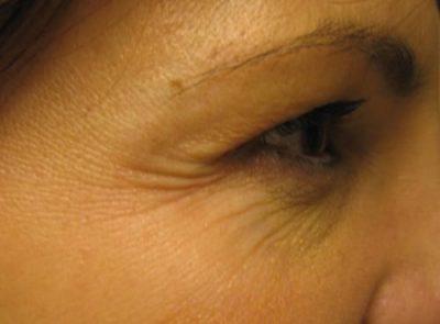 A Before photo of Botox by Dr. Craig Jonov