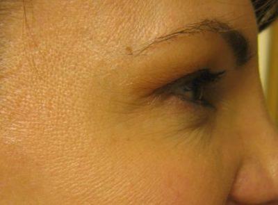 An After photo of Botox by Dr. Craig Jonov