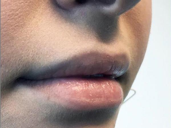 A Before photo of a Lip Filler Plastic Surgery by Dr. Craig Jonov