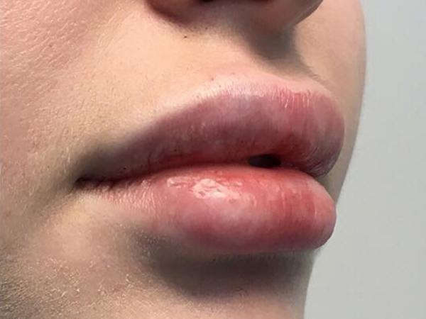 An After photo of Lip Filler Plastic Surgery by Dr. Craig Jonov