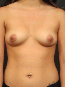 A Before photo of a Breast Augmentation Plastic Surgery by Dr. Craig Jonov