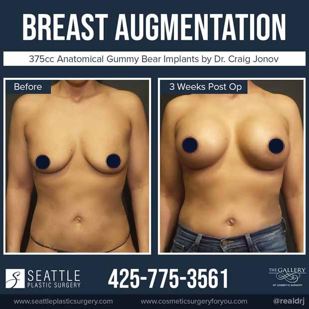 A Before and After photo of a Breast Augmentation Plastic Surgery by Dr. Craig Jonov