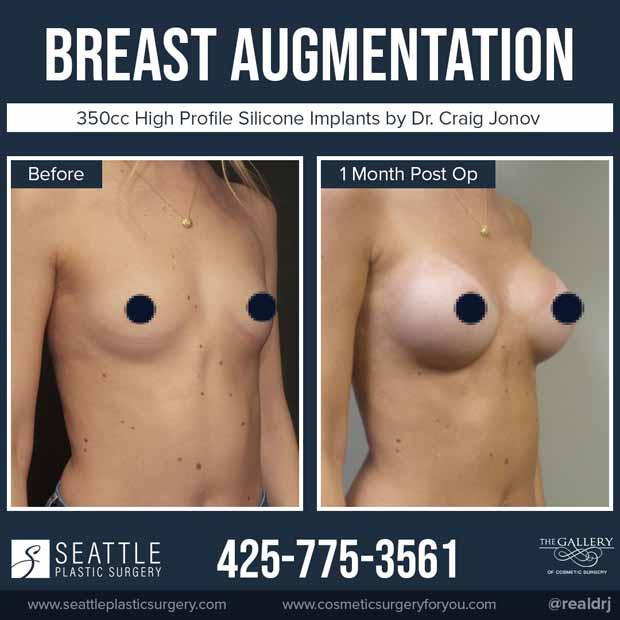 A Before and After photo of a Breast Augmentation Plastic Surgery by Dr. Craig Jonov