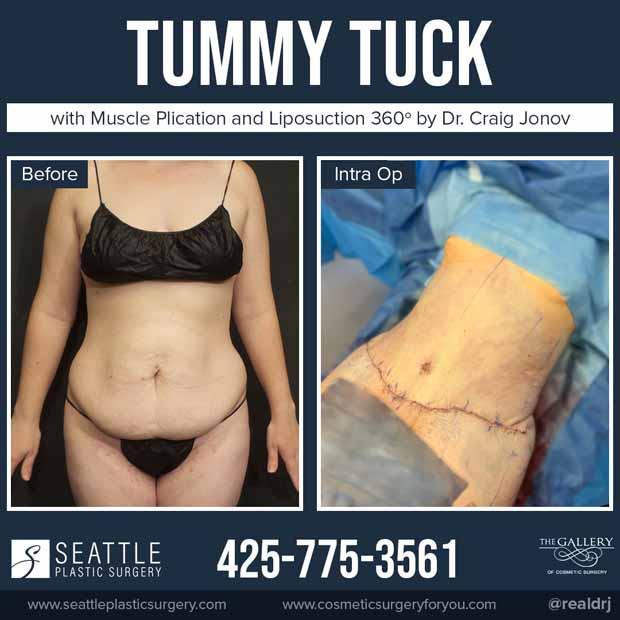 A Before and During photo of a Tummy Tuck with Muscle Plication and Liposuction 360 by Dr. Craig Jonov