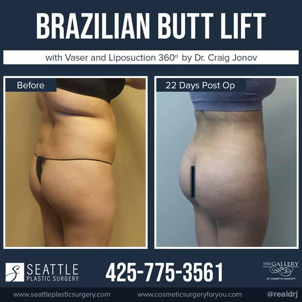 A Before and After Brazilian Butt Lift Plastic Surgery with Vaser and Liposuction 360 by Dr. Craig Jonov