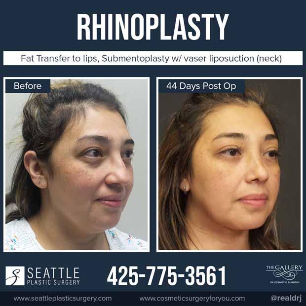 A Before and After photo of a Rhinoplasty with Fat Transfer to Lips,Submentoplasty with vaser liposuction (neck) Plastic Surgery by Dr. Craig Jonov