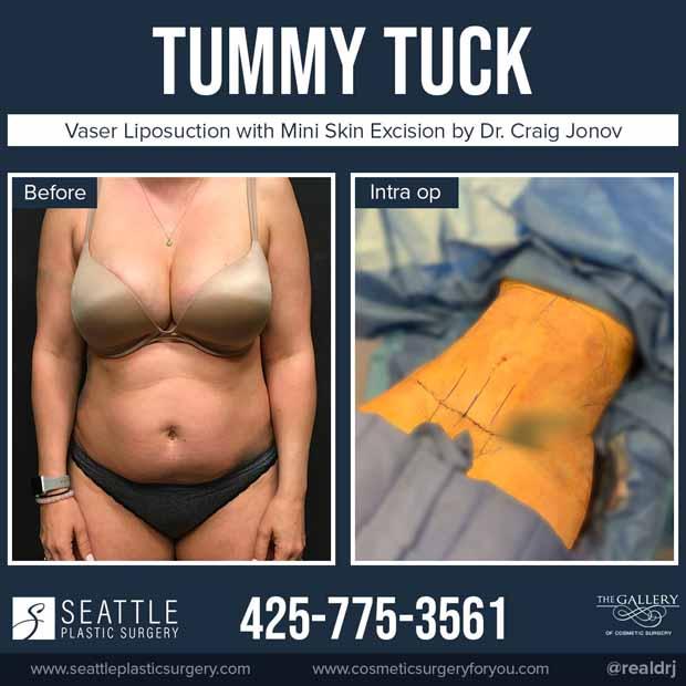 A Before and Intra Op photo of a Tummy Tuck Plastic Surgery by Dr. Craig Jonov