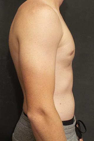 An After of a Gynecomastia Plastic Surgery by Dr. Craig Jonov